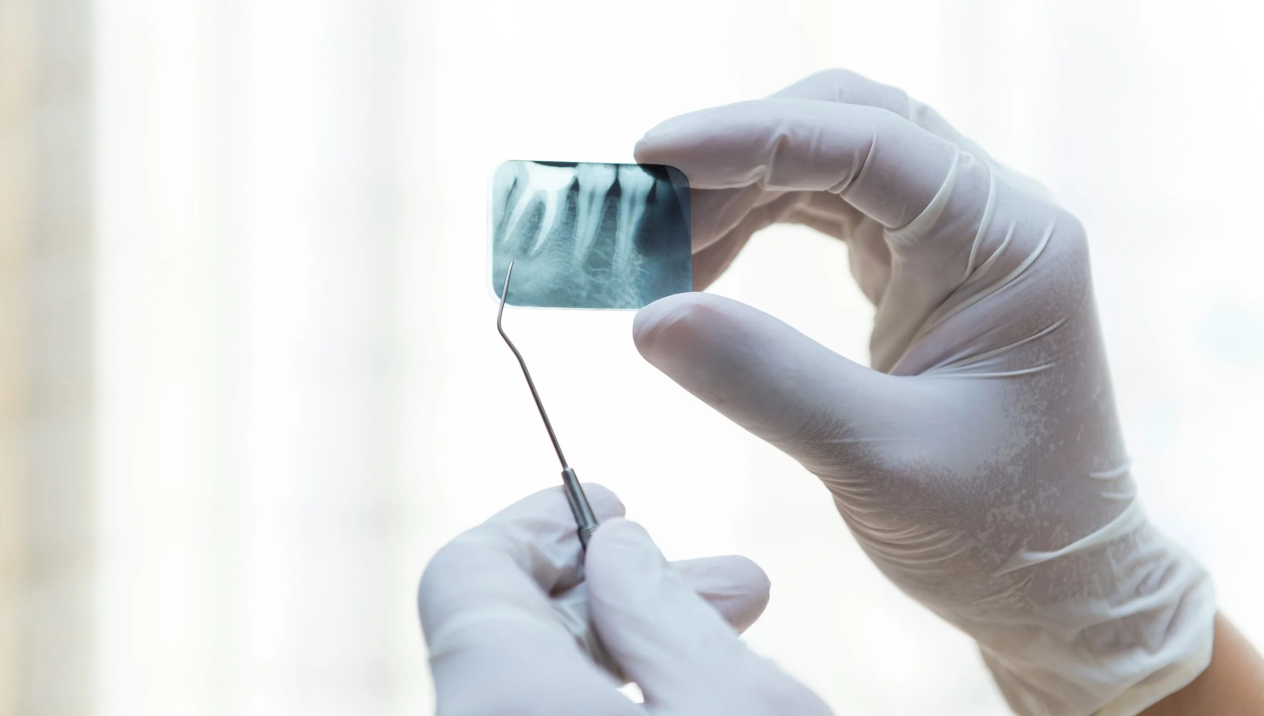 Wisdom Tooth Surgery at Jurong