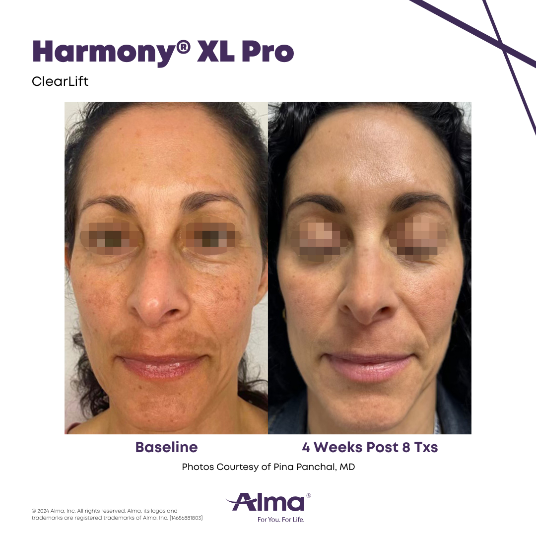 Harmony_XL_Pro_BA_P.Panchal_Q4-24_14656881803_Canva.png