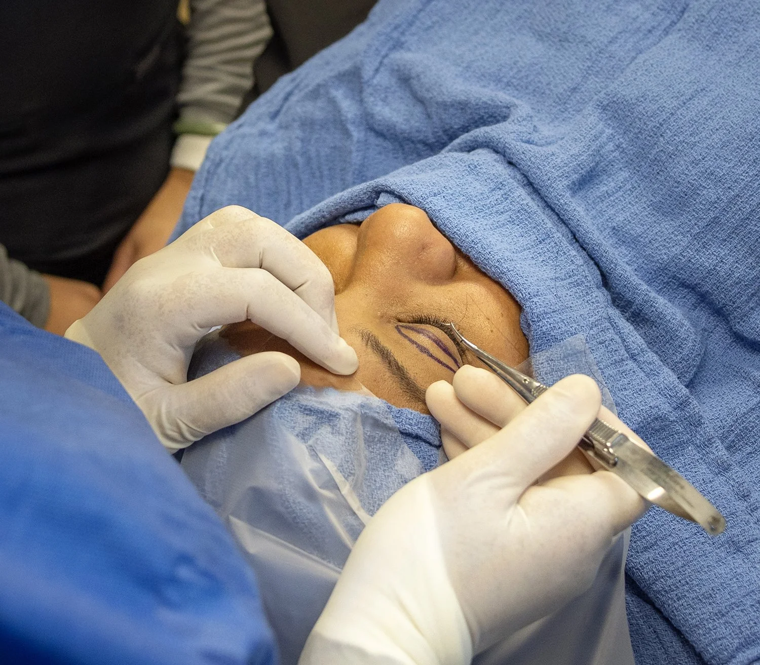 Brow Lift vs. Blepharoplasty: Is Your Eyelid Hooding Coming From Your Brow or Your Eyelid?