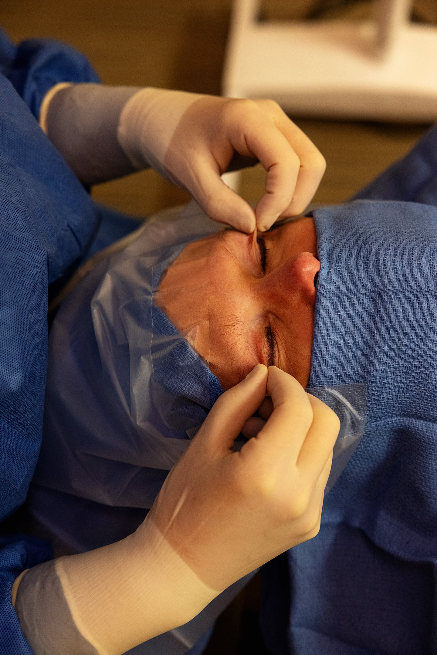 Droopy Eyelids: Is It Ptosis, Excess Skin, or a Low Brow?