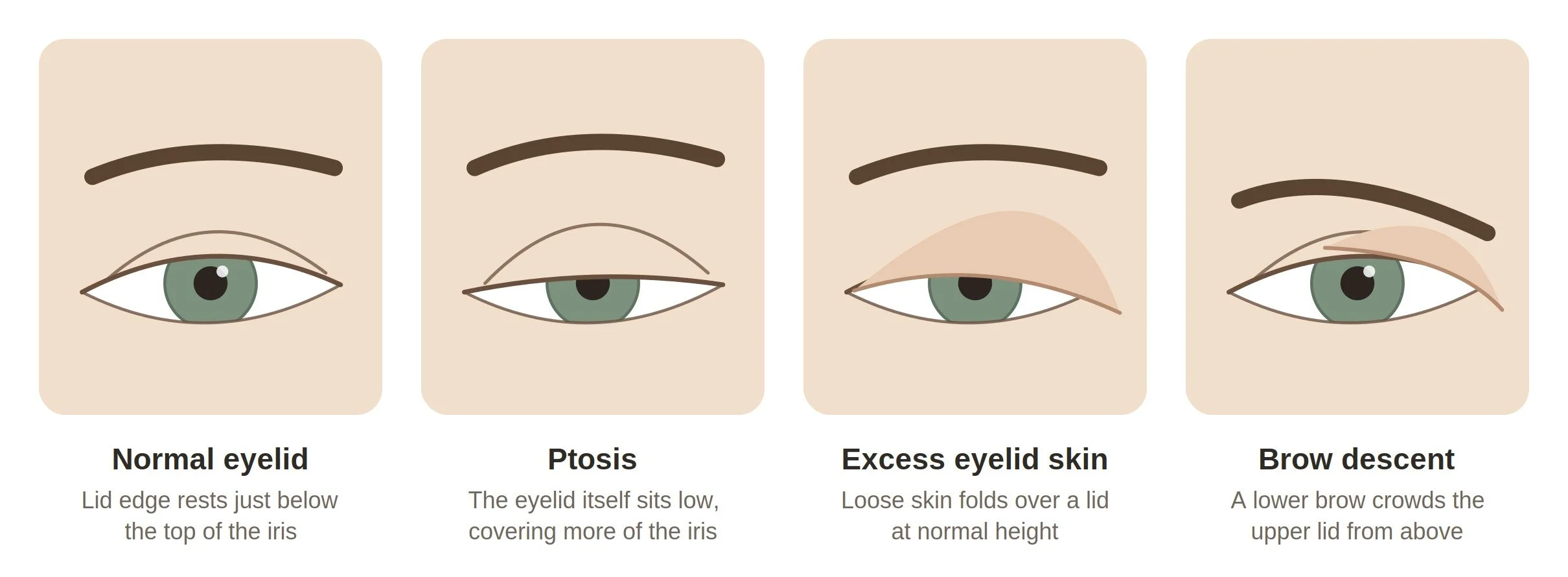 Illustration comparing a normal upper eyelid with ptosis, excess eyelid skin, and a lowered brow .