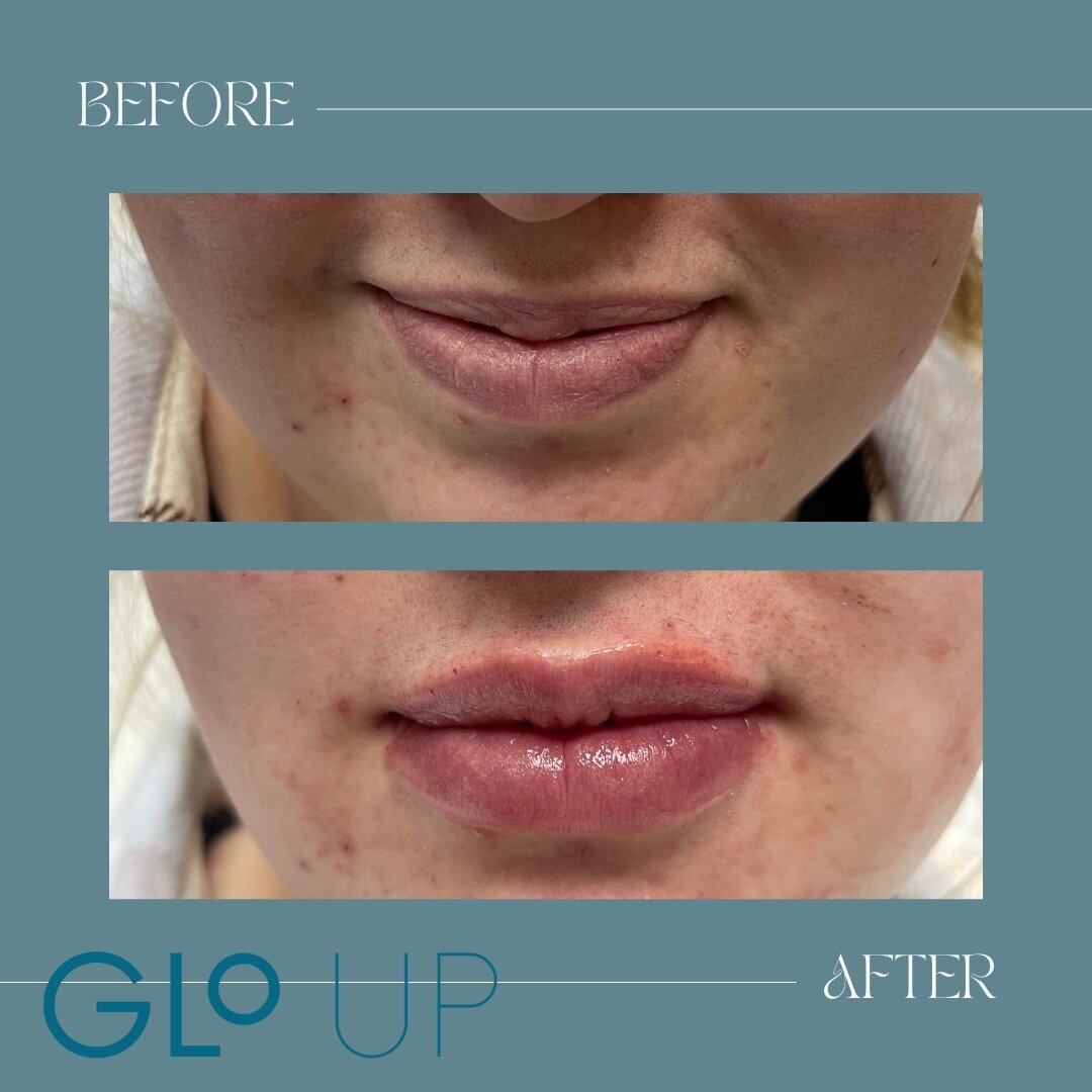 Here is a little hump day lip refresh💋.
It is important to slowly fill lips to avoid over filling, which can lead to migration. Otherwise know as the dreaded &quot;Duck Lip&quot;.
We used .5cc Juvederm Volbella for a natural improvement in color, hy