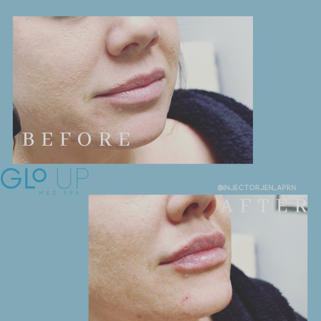 Lip/chin balancing👏
Why is it important to balance out the lower face when doing a lip augmentation? This is because it will support those beautiful voluminous lips! Plain and simple....it gives you a beautiful result. 
This client comes in once a y