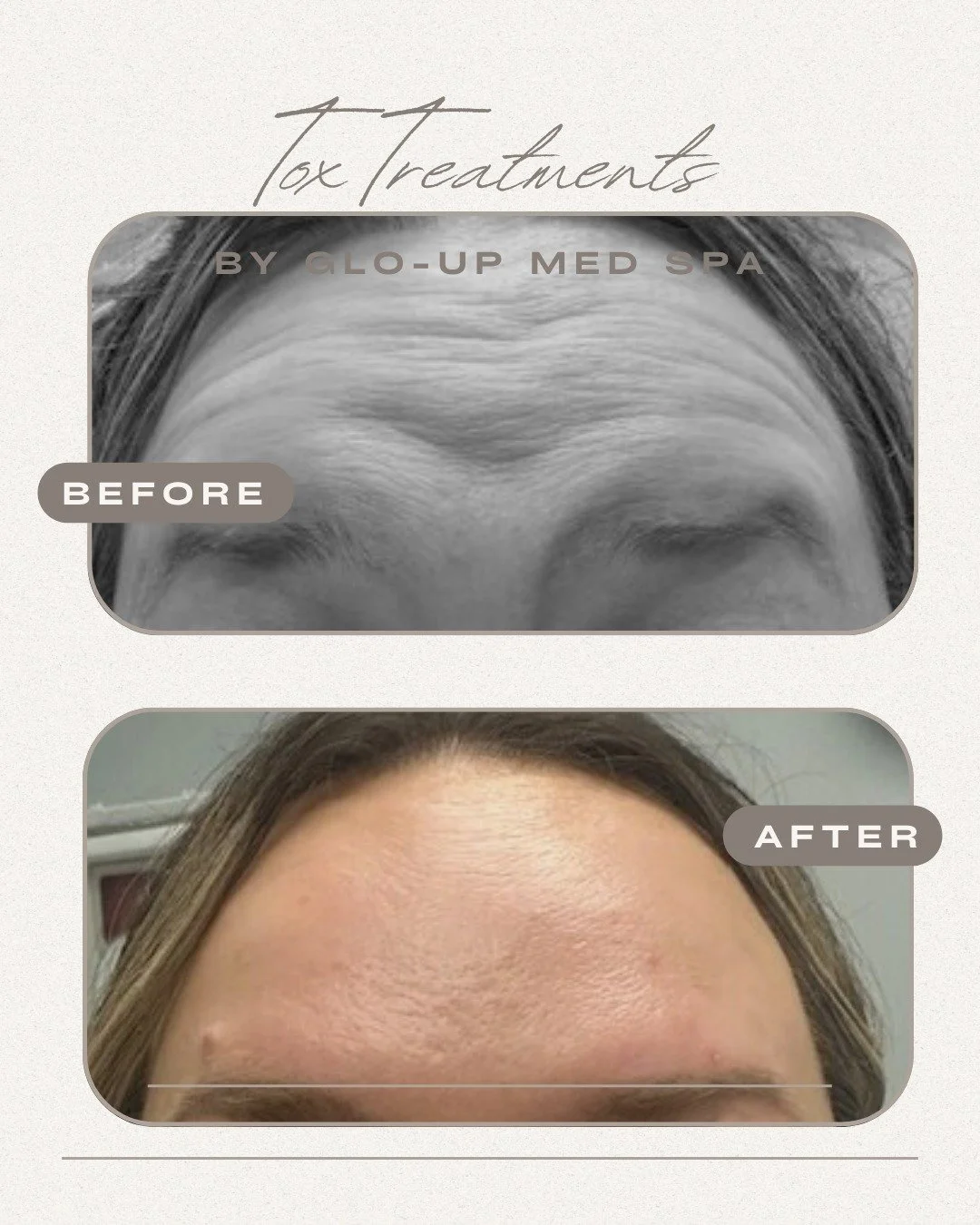🧠 What are Neurotoxins?
Botox, Xeomin, and Dysport are wrinkle-relaxing injectables that temporarily smooth fine lines by relaxing facial muscles.
✅ FDA-approved
✅ Quick + minimally invasive
✅ Perfect for frown lines, crow&rsquo;s feet, forehead lin