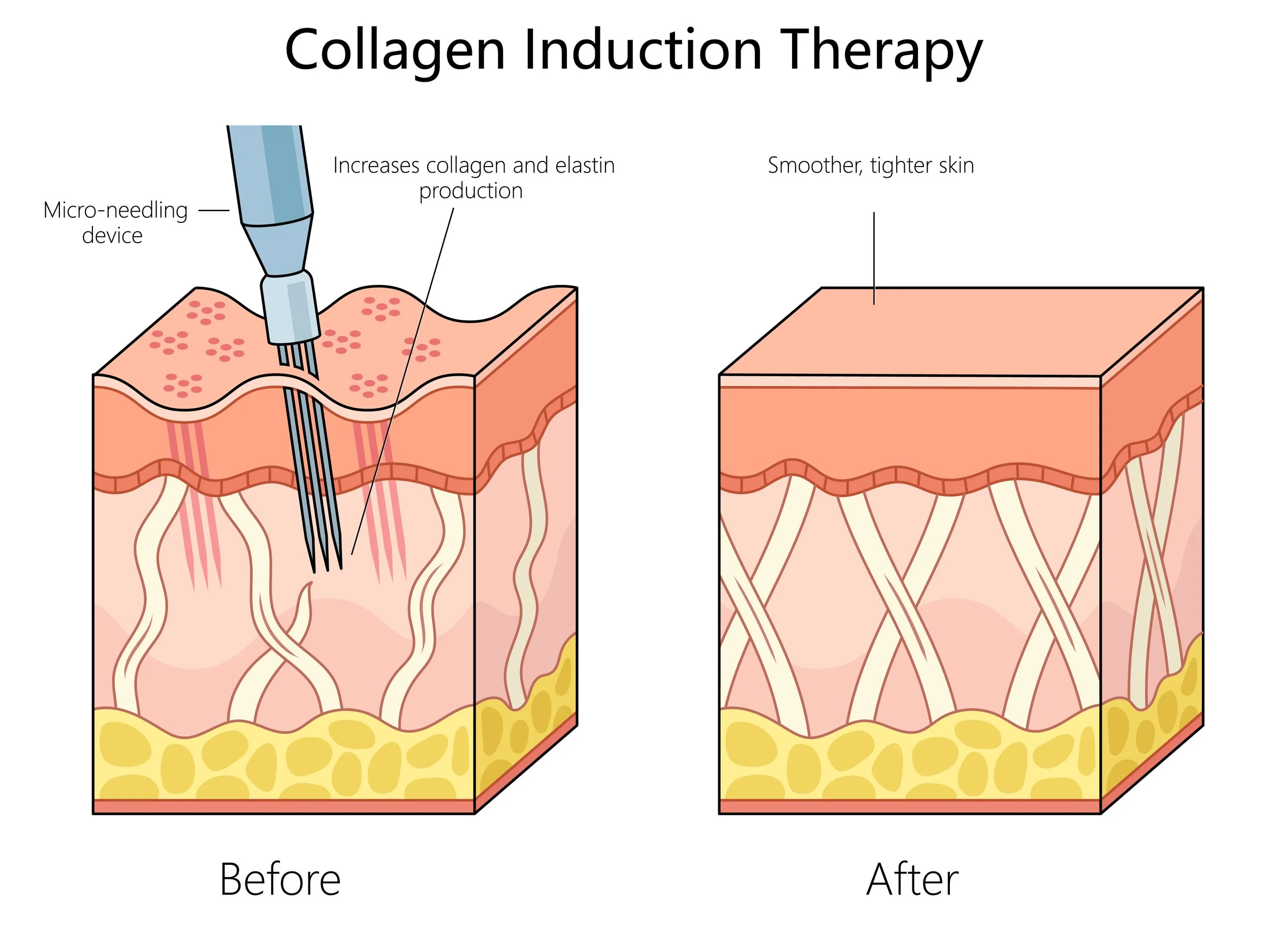 Illustration depicting collagen induction therapy. The left side labeled 'Before' shows skin with micro-needling devices creating tiny punctures to stimulate collagen and elastin production, leading to smoother, tighter skin on the right side labeled 'After'.