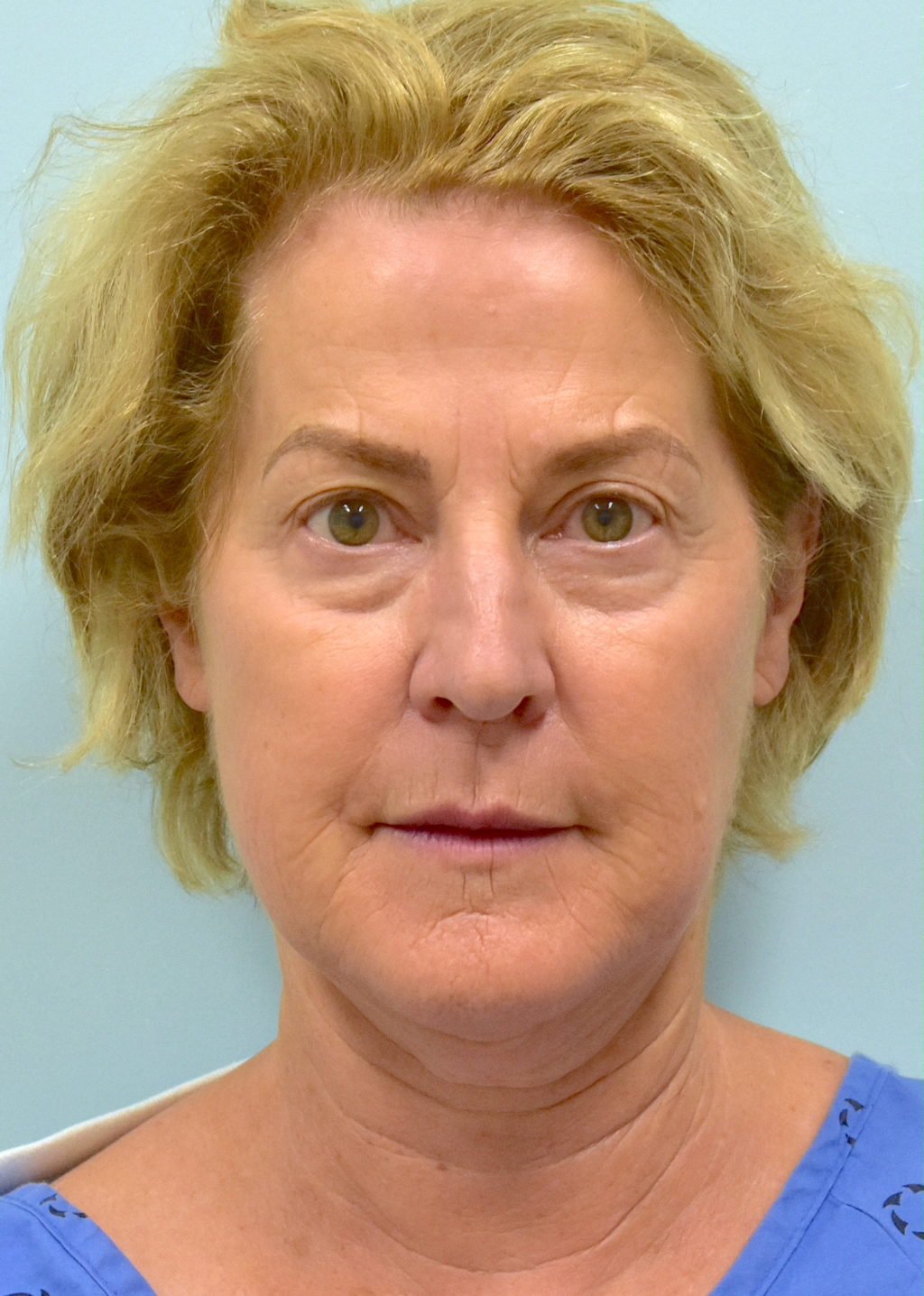 facelift before.jpg