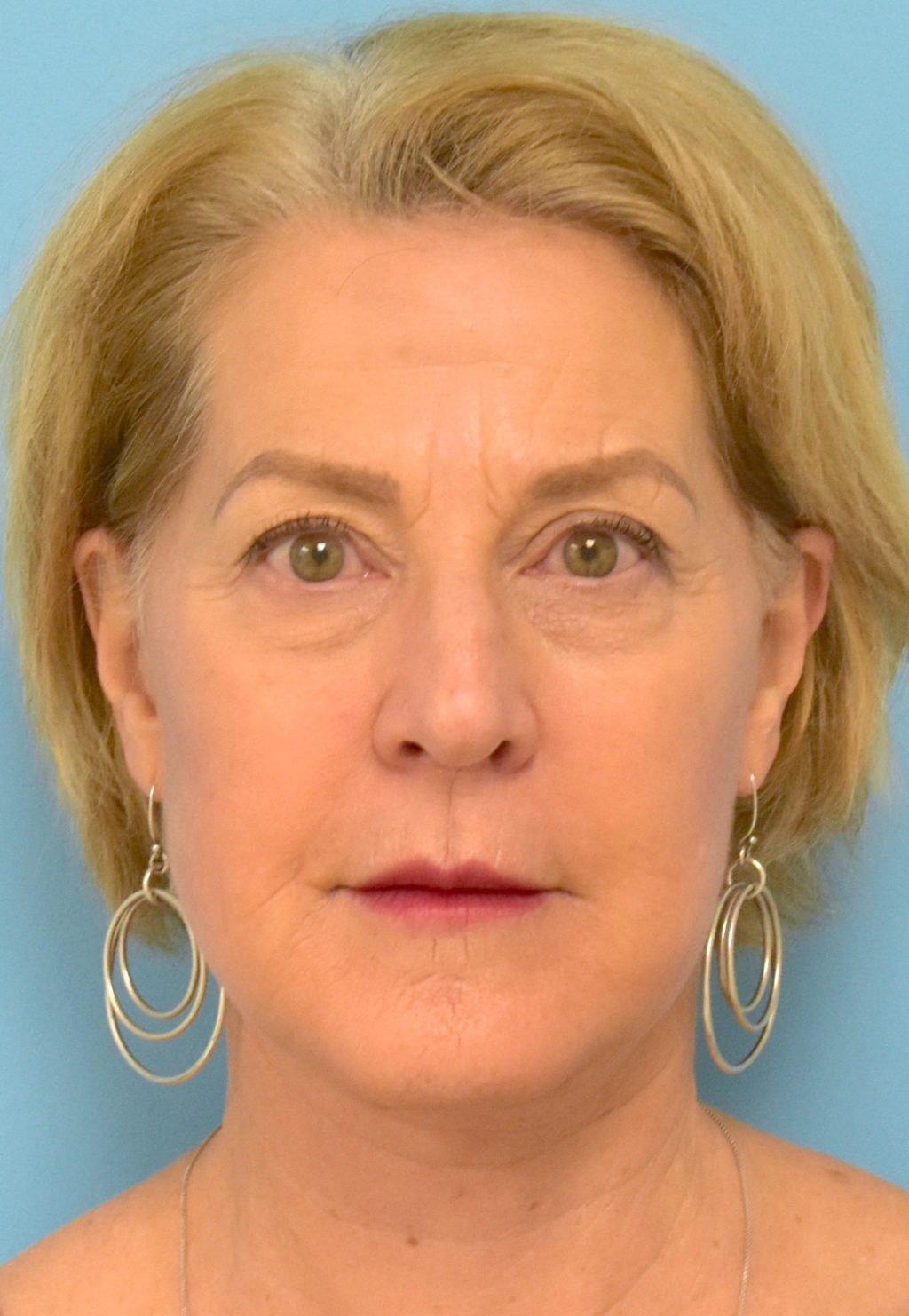 facelift after.jpg