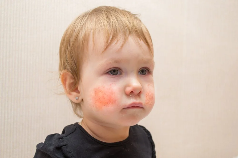 How can parents naturally support their child when dealing with persistent eczema flares?