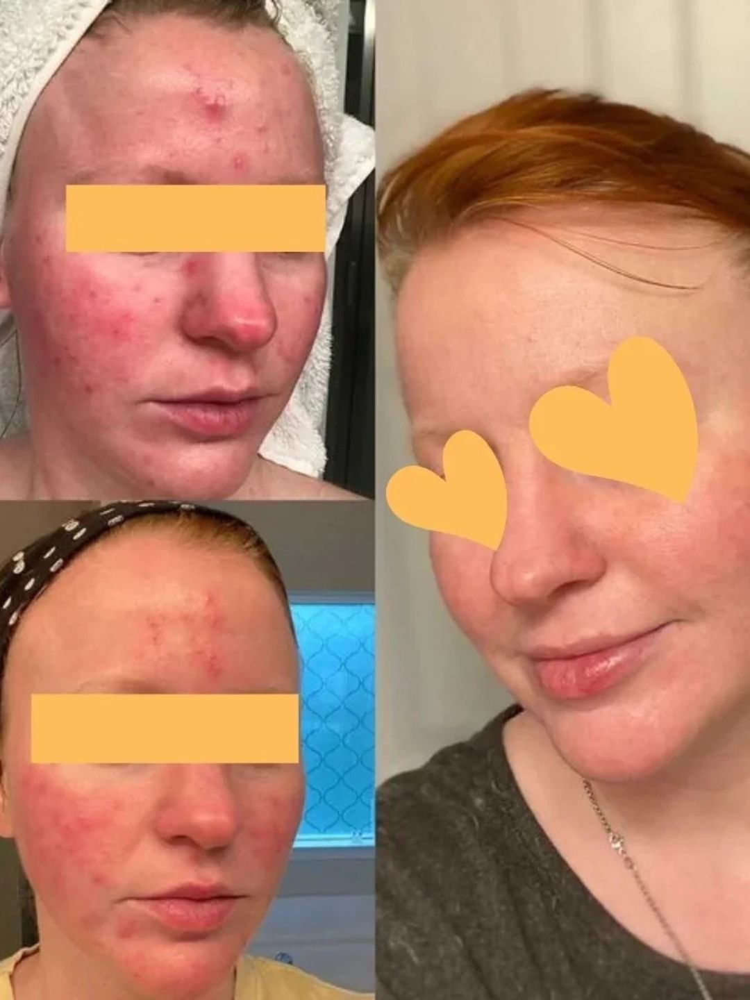 Concentré Anti-Acné | Plant Voodoo - The Other Skincare Company