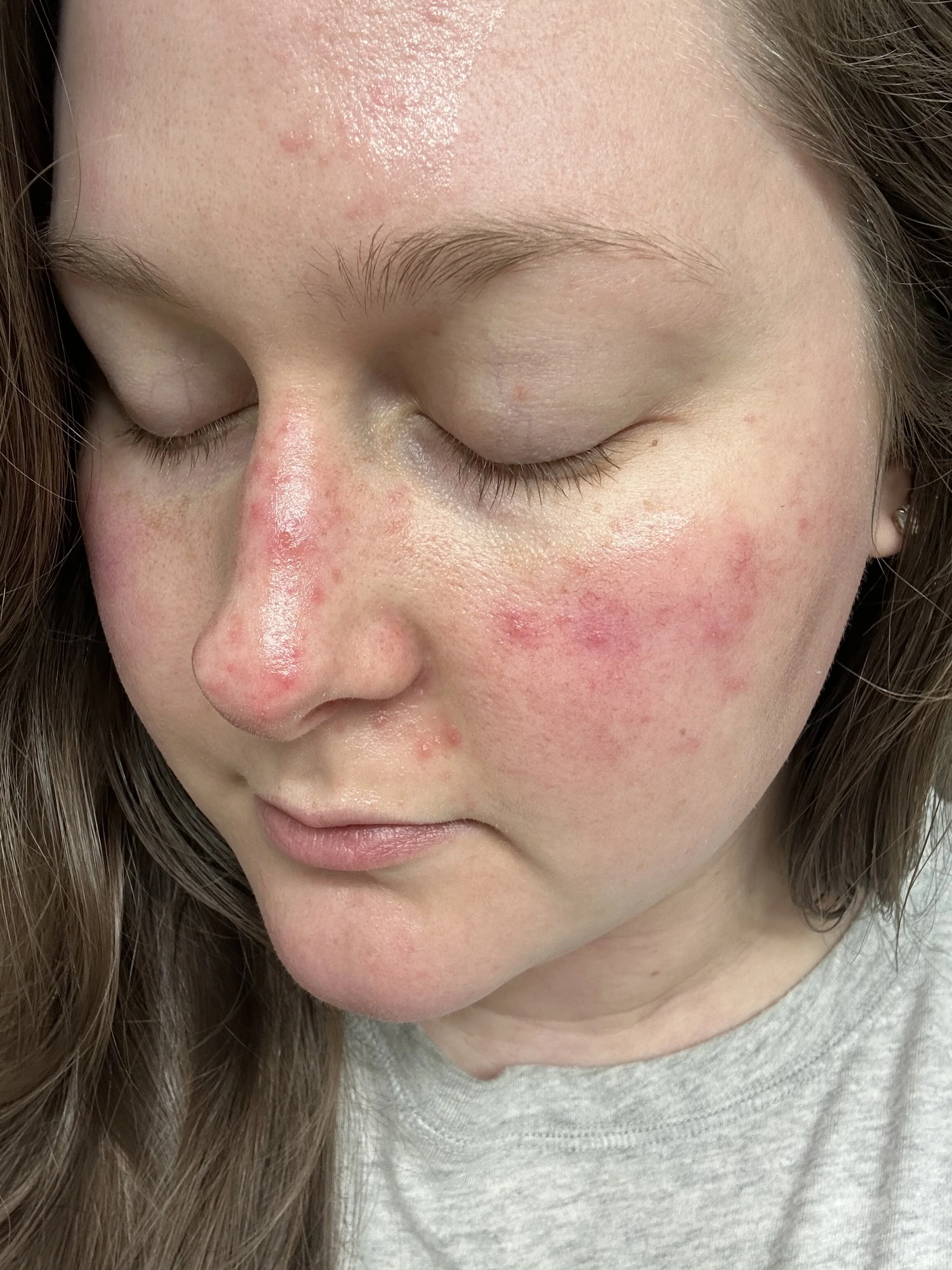 Close-up of a young woman's face with redness and irritation on her nose, cheeks, and forehead.