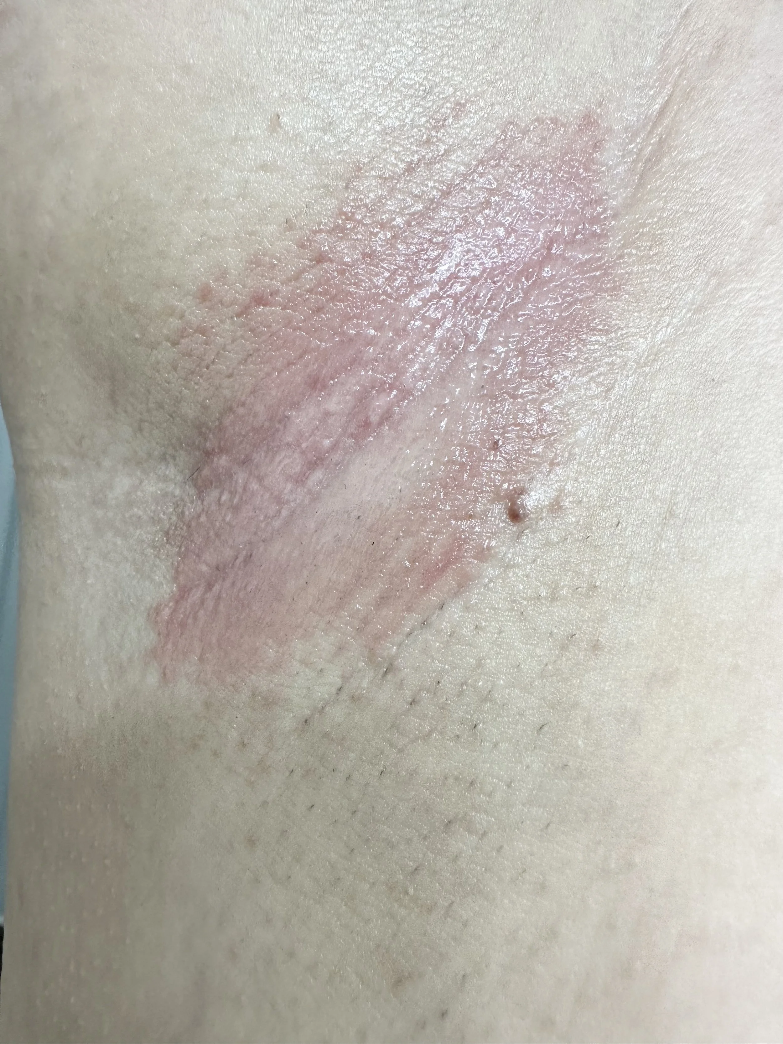 Close-up of irritated, pink, scaly skin with dry patches on a person's body.