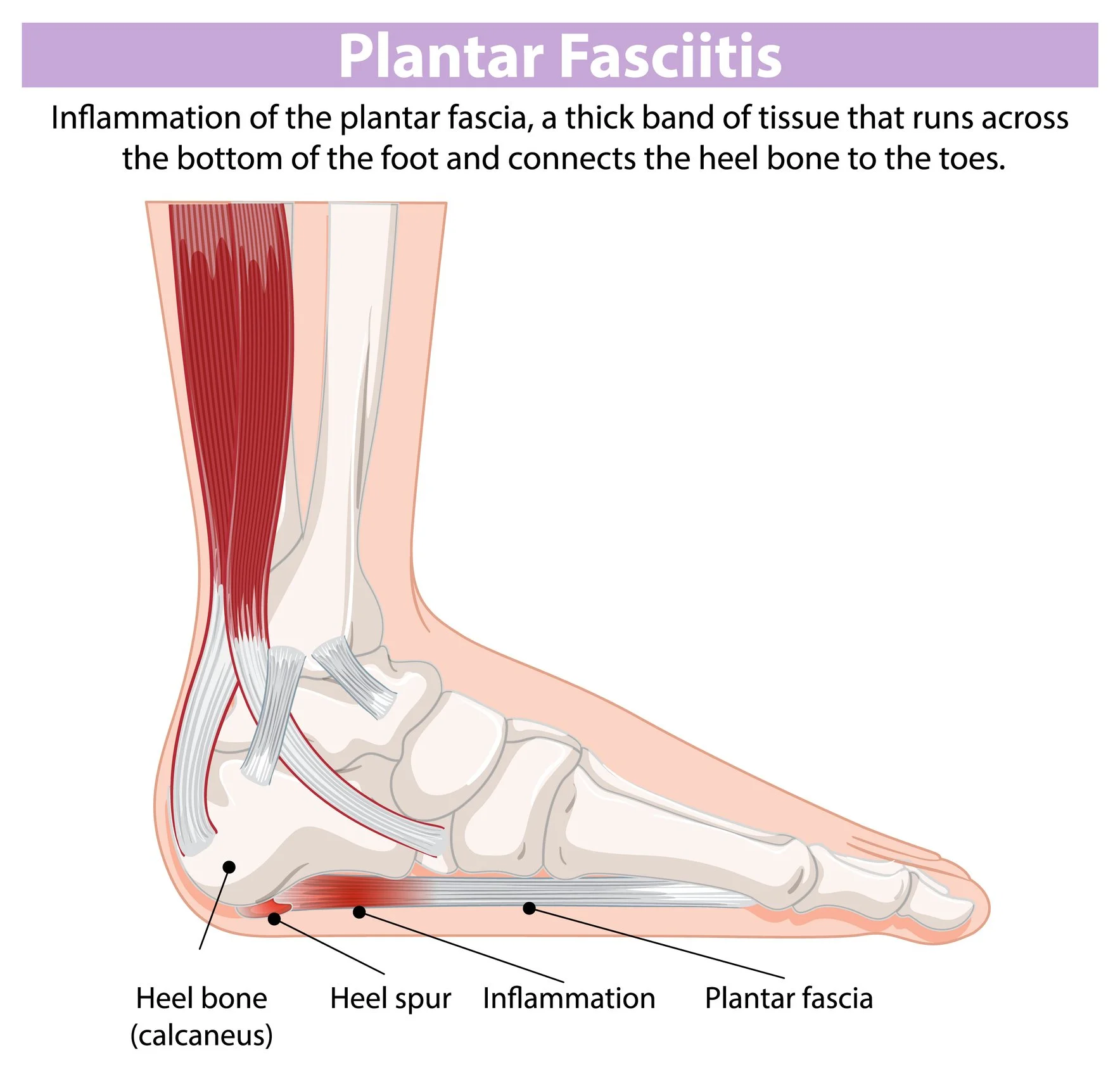 HEEL PAIN CAUSES AND TREATMENT — Dr. Lee S. Cohen and Associates