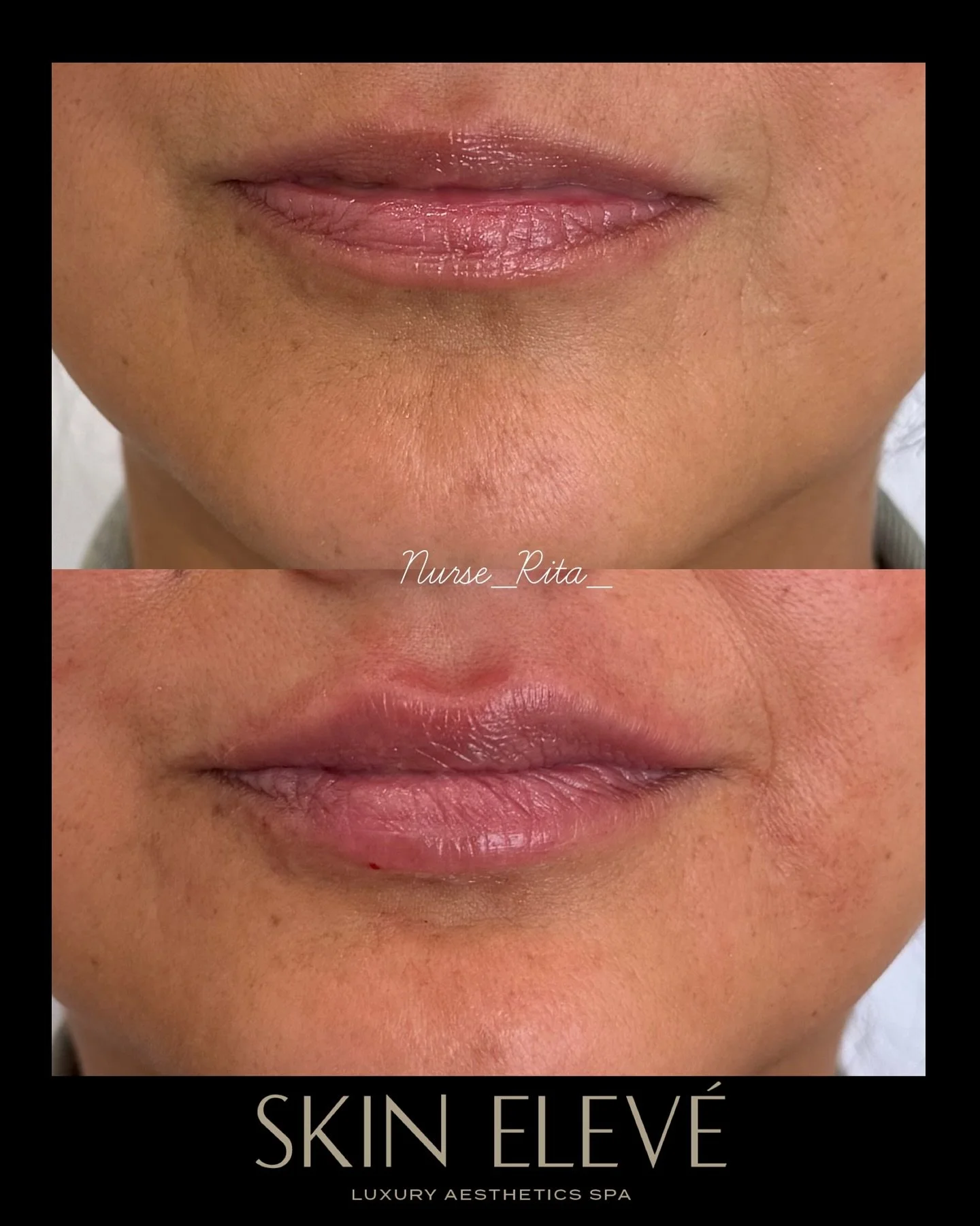 Just a lil&rsquo; plump 👄 #skineleve #beyouelevated #lipfillers #naturallipfiller #bestmedspa 
RN 💉Rita K.

CALL ☎️ 747-202-0304
TEXT 📲 818-441-7870
Book ONLINE with the &ldquo;BOOK NOW&rdquo; button.

📍LOS ANGELES 
10316 Topanga Canyon Blvd. 
Su