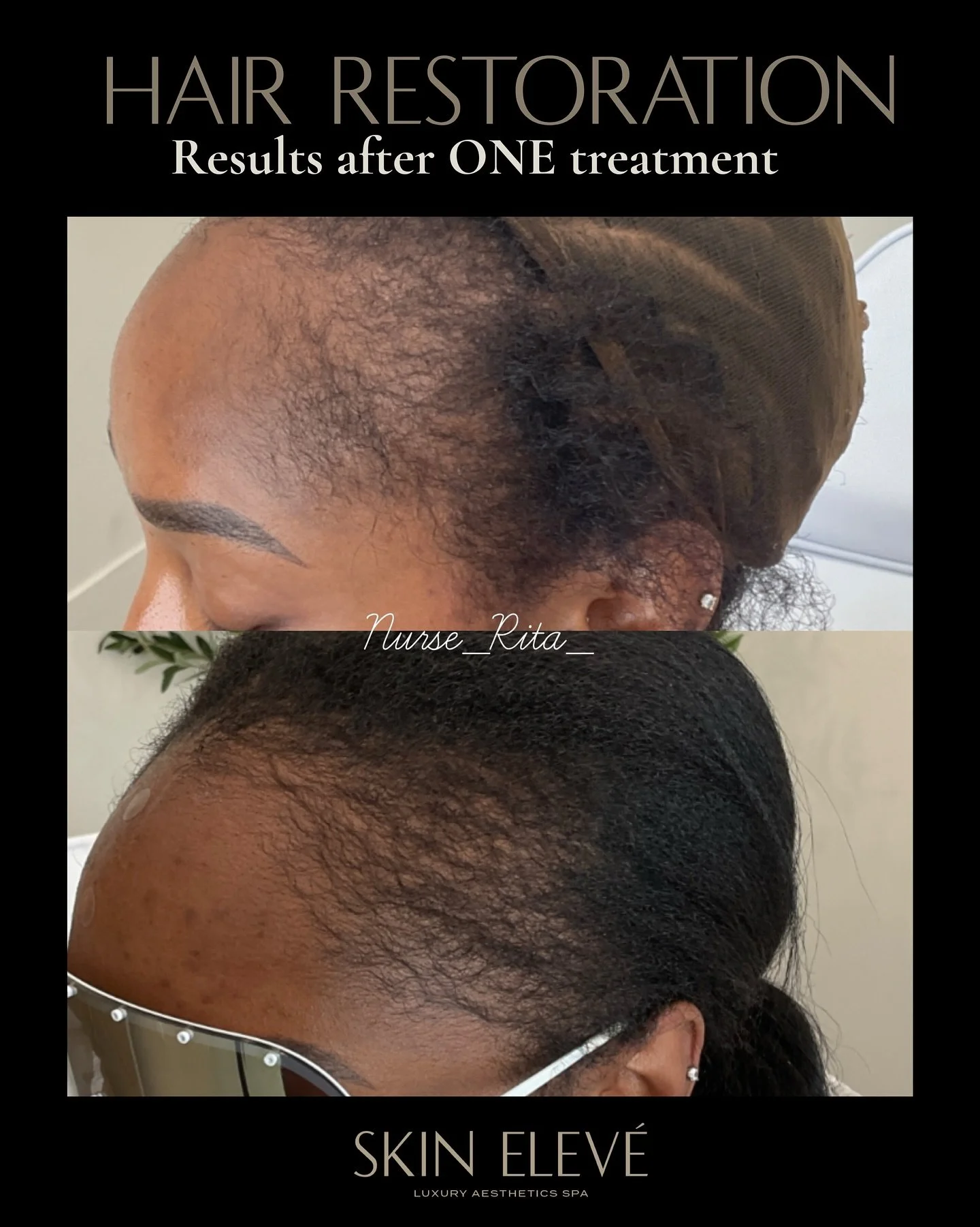 Confidence restored one hair follicle at a time. Results from ONE treatment of hair restoration. She will be getting more combination treatments to further stimulate the quality and growth of her hair. Each client is unique and therefore we customize