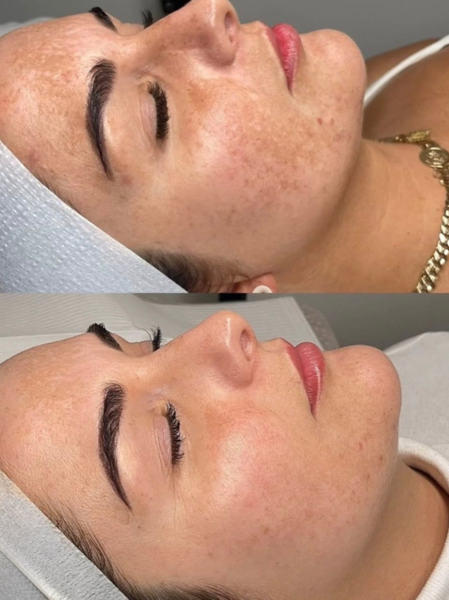 Aerolase+melasma+b%2Ba.png