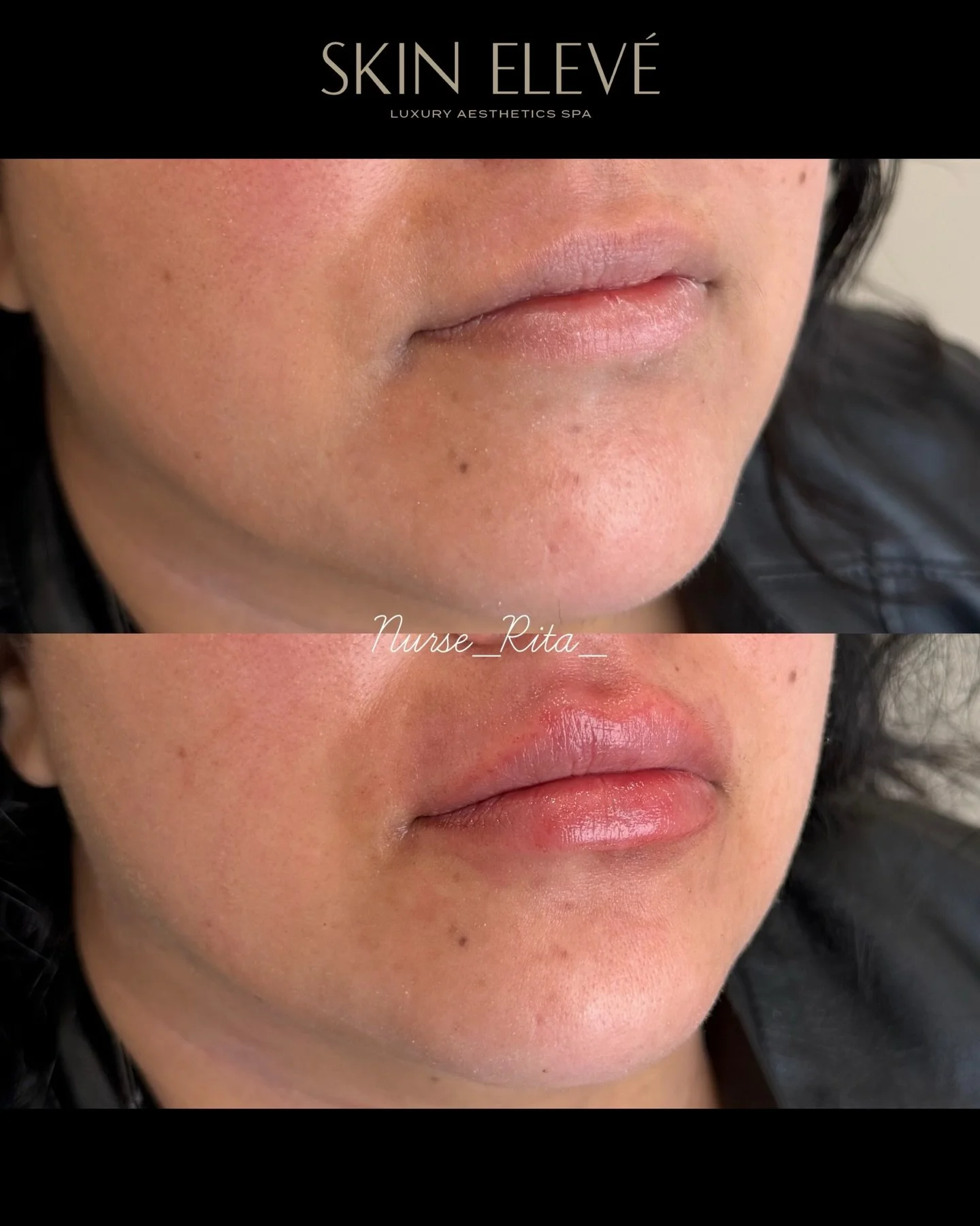Defined, never overdone. #lipfillers #skineleve #beyouelevated 

CALL ☎️ 747-202-0304
TEXT 📲 818-441-7870
Book ONLINE with the &ldquo;BOOK NOW&rdquo; button.

📍LOS ANGELES 
10316 Topanga Canyon Blvd. 
Suite B
Chatsworth, Ca 91311

✨Convenient FREE 