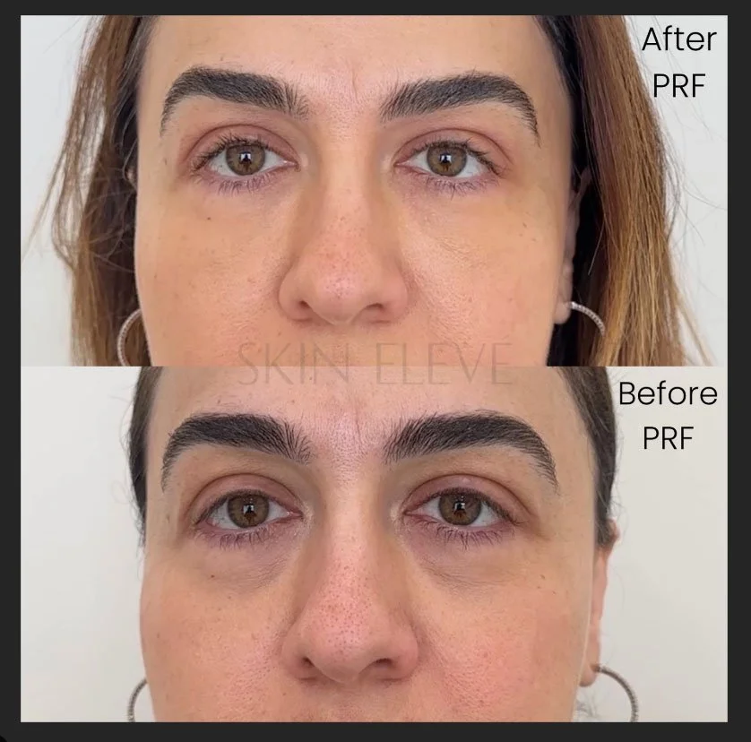 before and after undereye