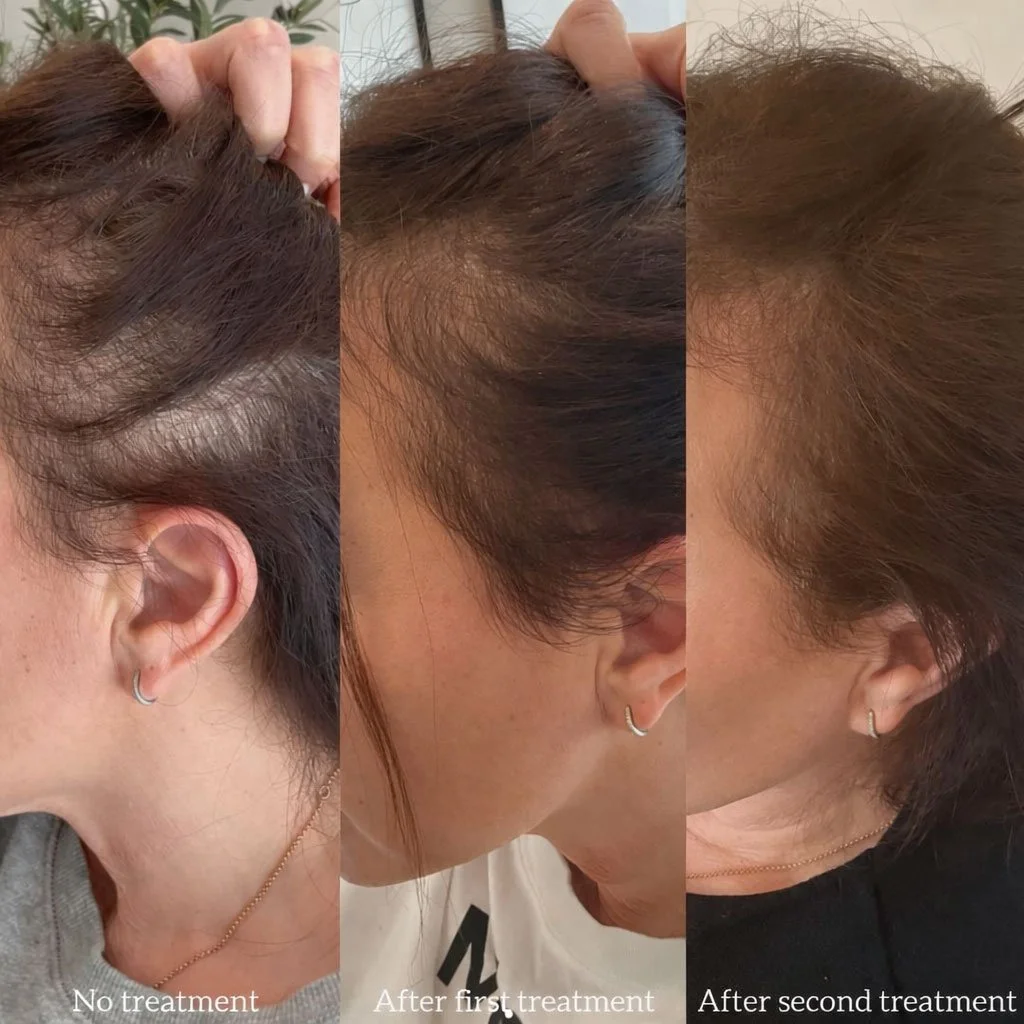 Hair Restoration before and after