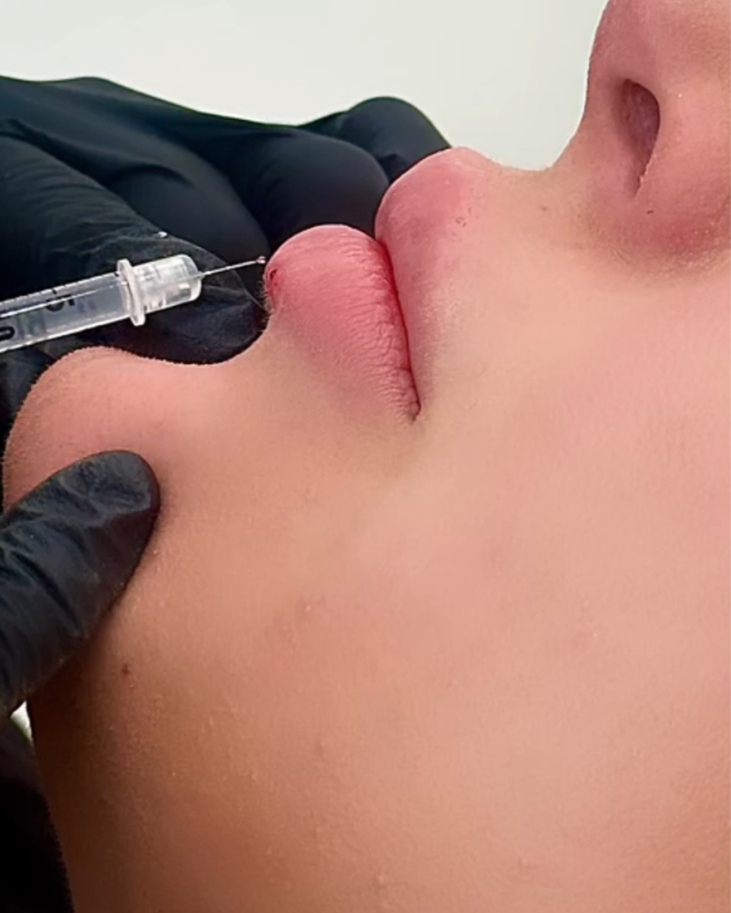 Gloved injector performing Skin Eleve lip filler treatment