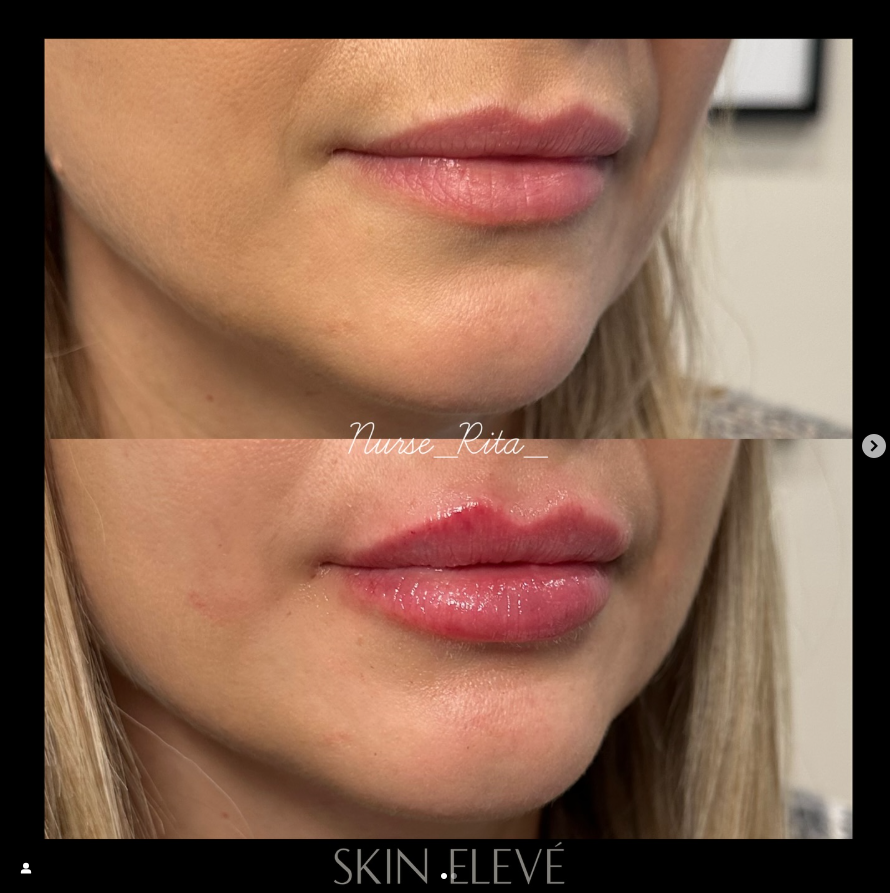 before and after lip filler