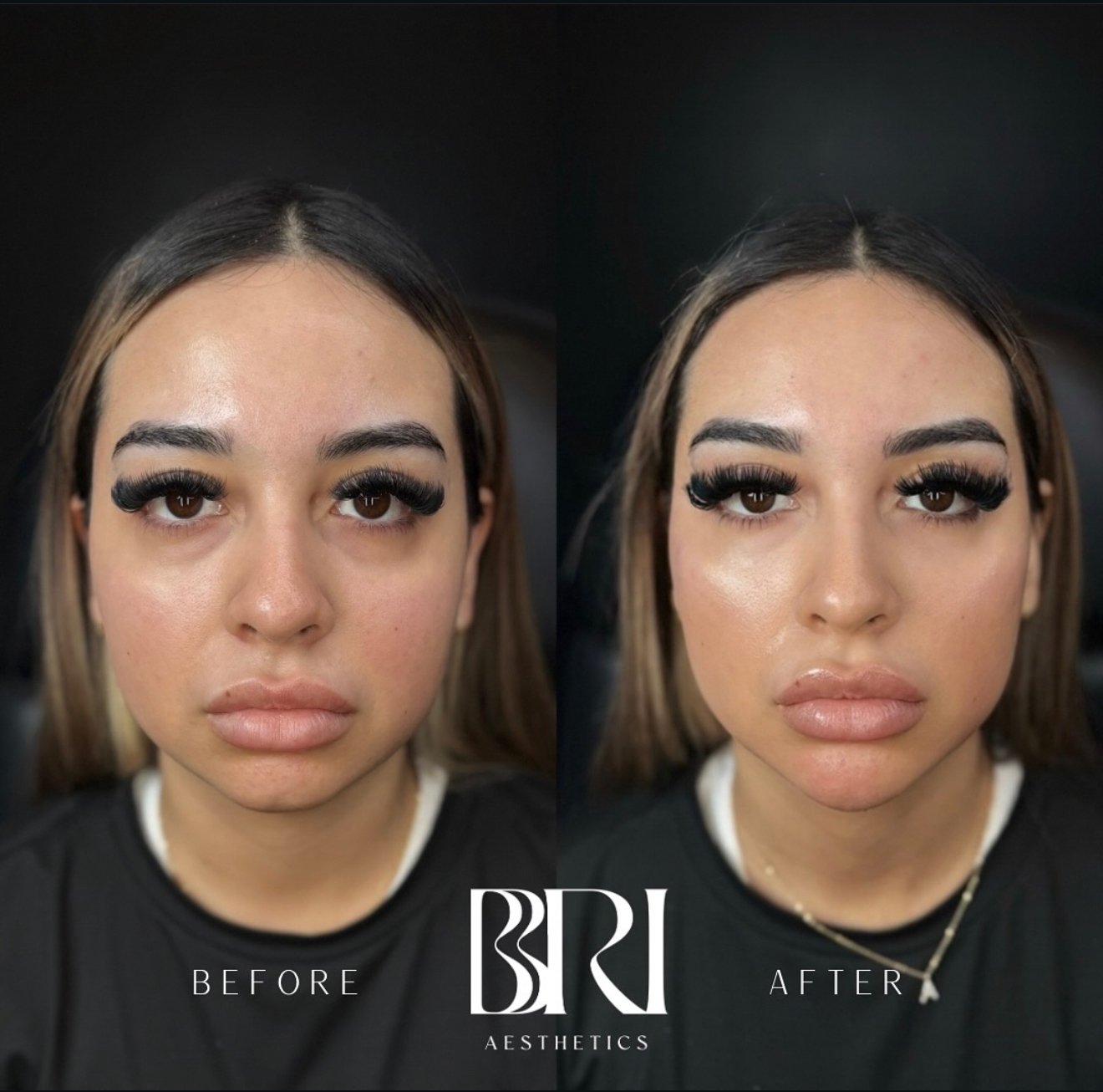 Side-by-side comparison of a woman's face before and after aesthetic treatment, showing smoother skin and fuller lips in the after image.