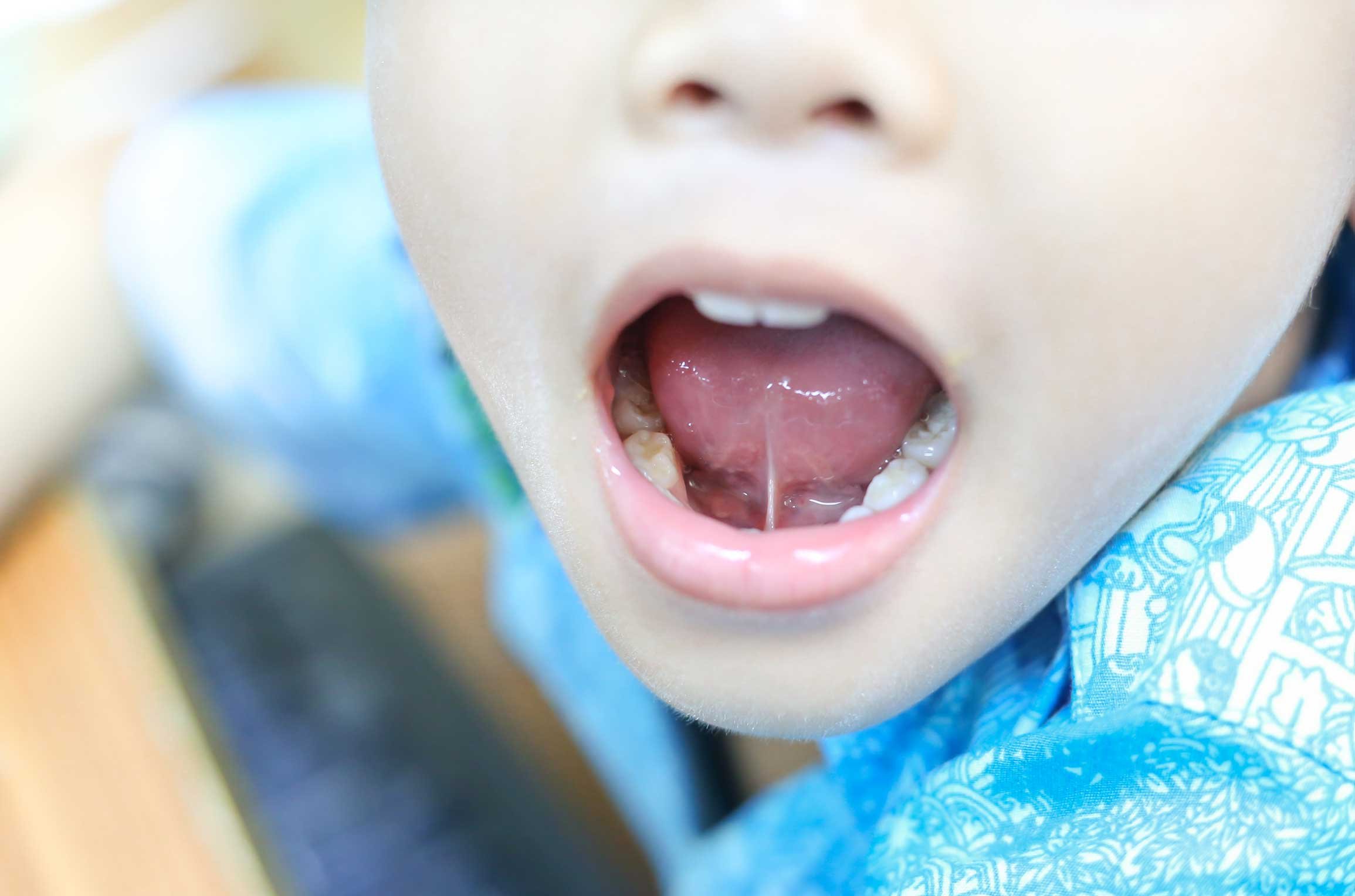 Tongue Tie