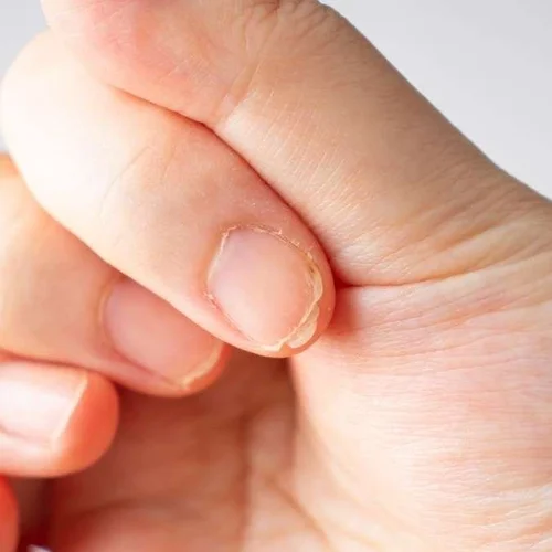 Brittle, peeling nails