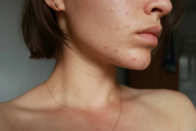 Adult with hormonal acne breakouts