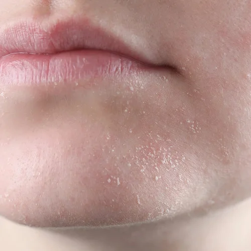 Dry, itchy, reactive skin