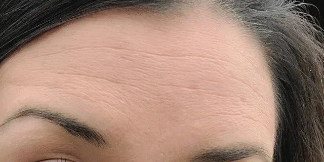 Early fine lines around the eyes