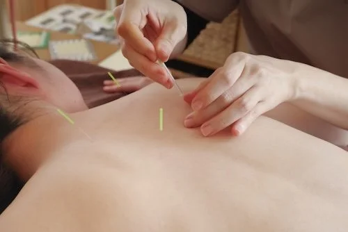 Acupuncture procedure with thin needles inserted into a person's back