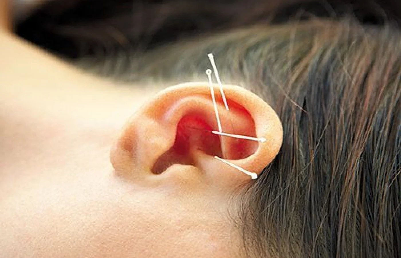 Close-up of a human ear with acupuncture needles inserted.