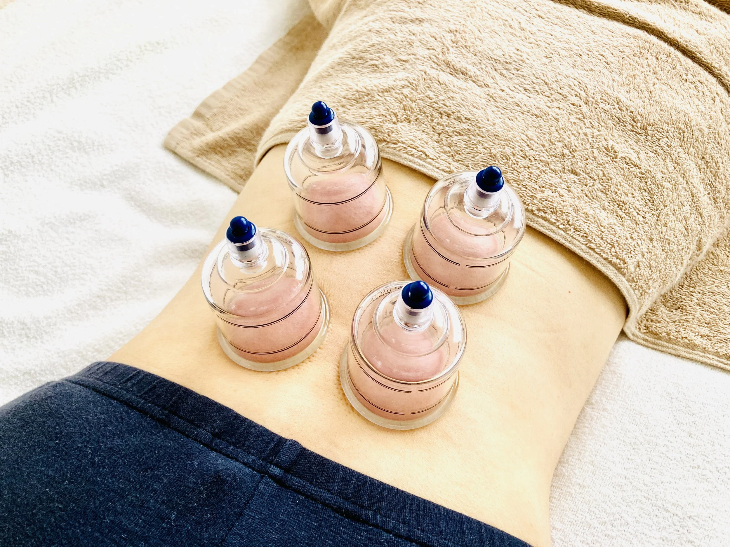 A person lying face down on a massage table receiving cupping therapy with four glass cups placed on their back.