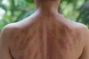 Back of a person with red, inflamed rash or stretch marks across the shoulders and upper back.