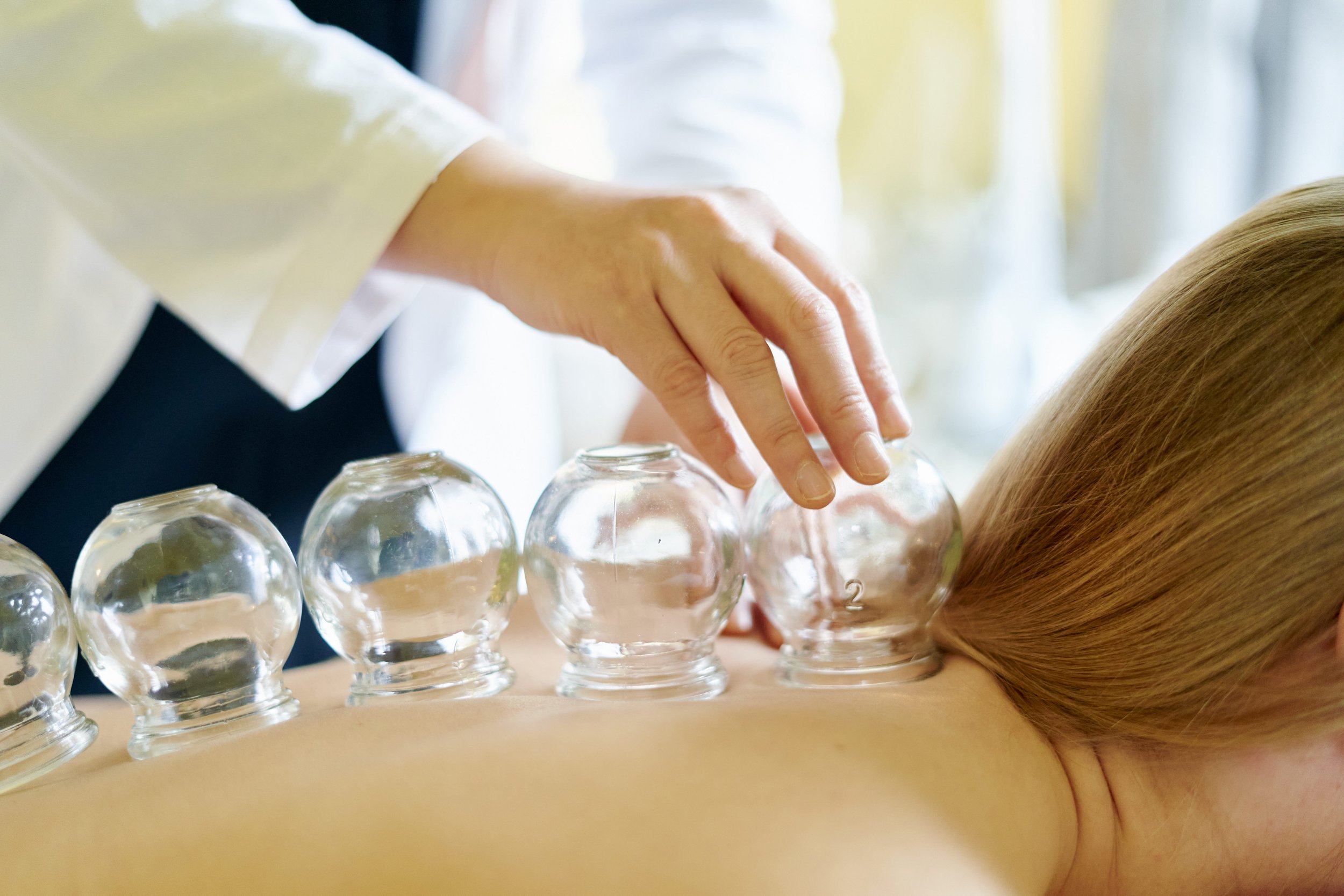 A person receiving cupping therapy with multiple glass cups placed on their back.
