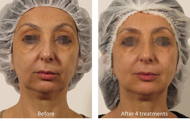 before-and-after-oxygeneo-8.jpg