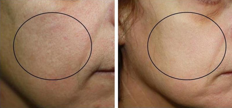 before-and-after-oxygeneo-10.jpg