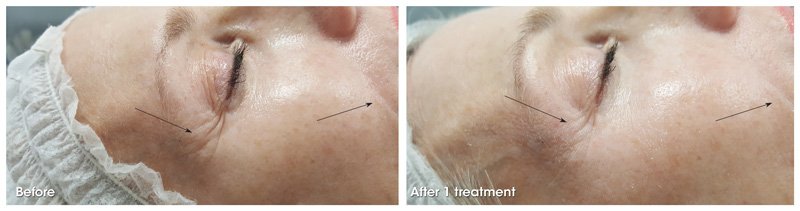 before-and-after-oxygeneo-6.jpg