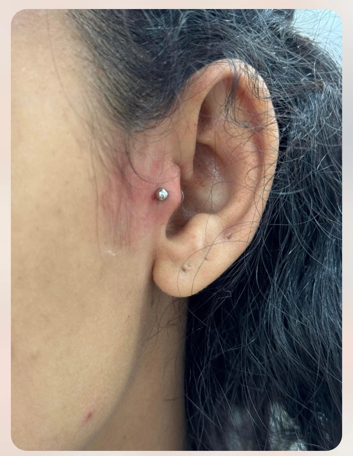 Daith piercing by Chantelle at Laser Luxe and Body Piercing in San Remo, on the Bass Coast