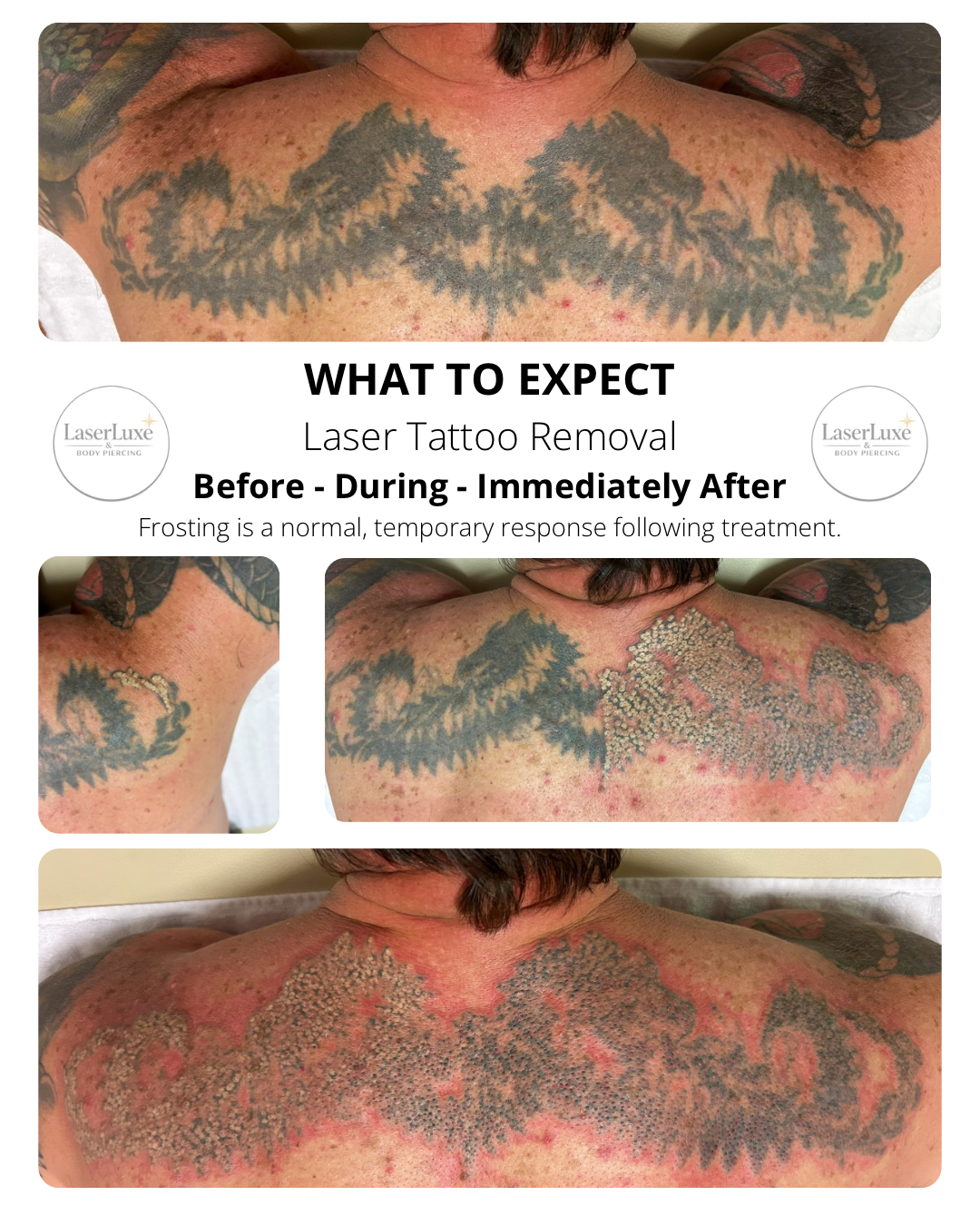 What to expect during your Laser Tattoo Removal Session at Laser Luxe and Body Piercing in San Remo on the Bass Coast, Victoria.