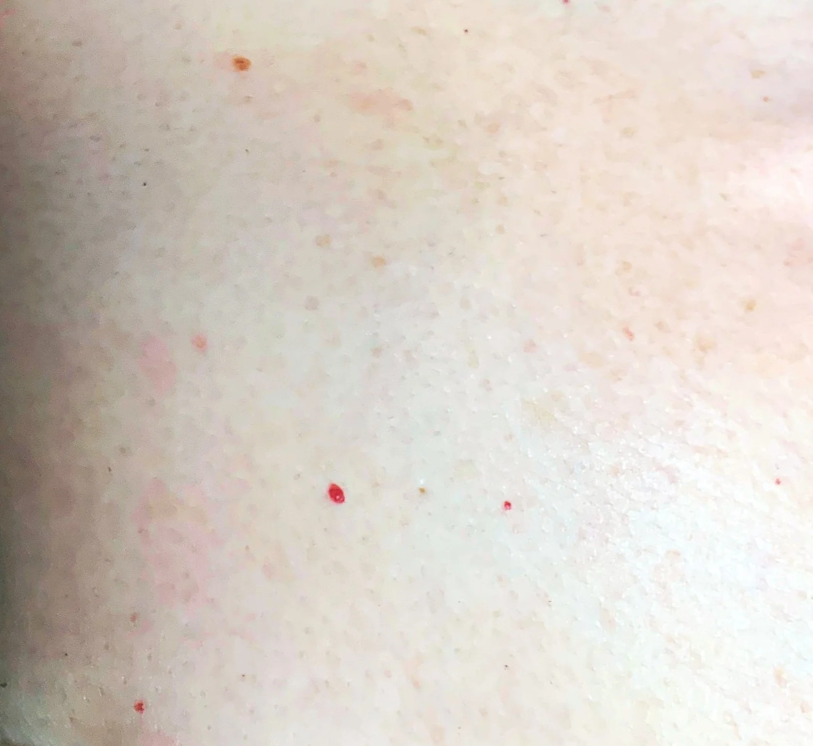 Cherry angioma