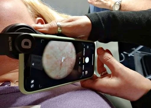 image of a skin tag seen through a phone camera