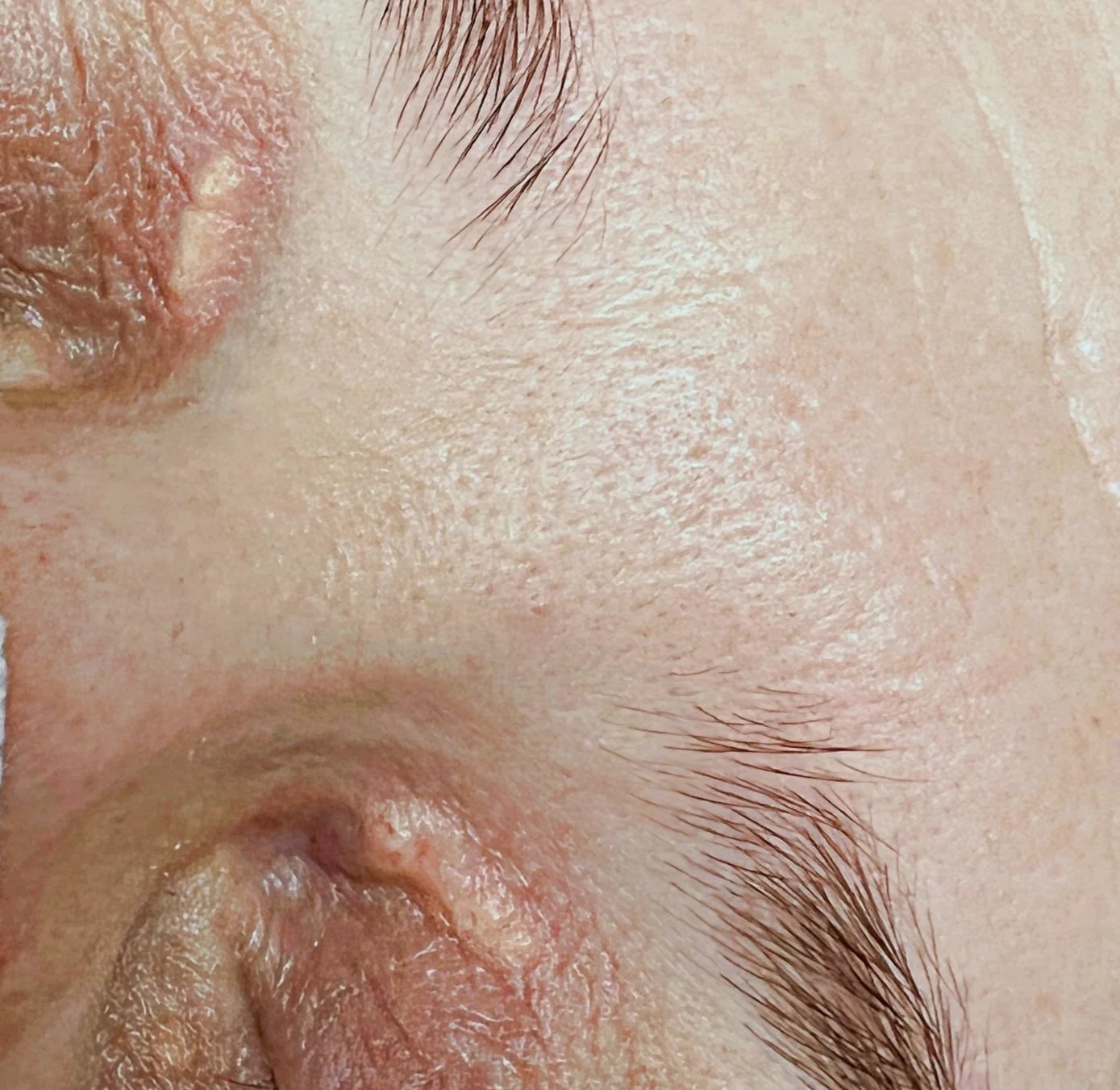 Xanthelasma