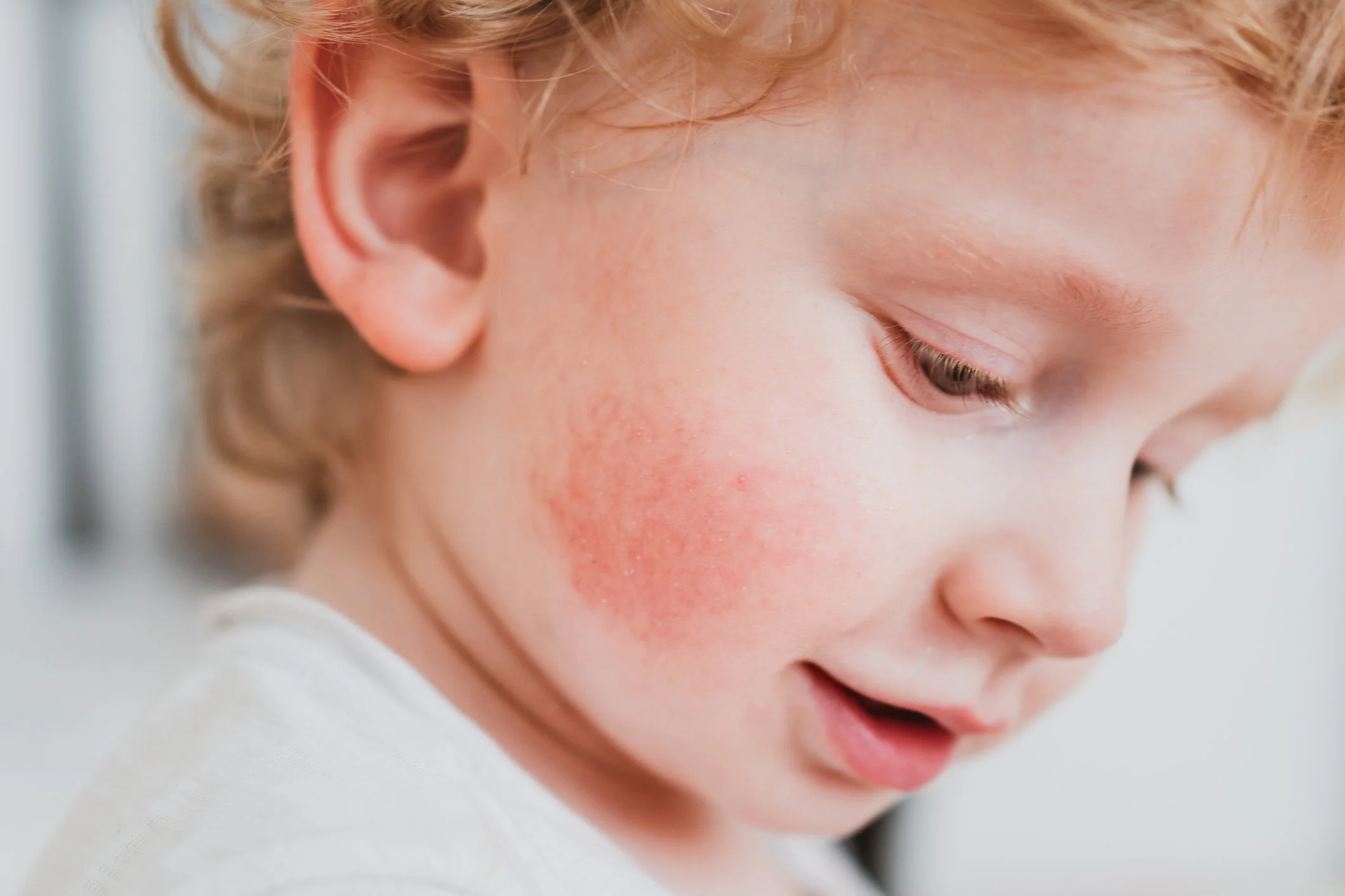 Why Early Treatment for Eczema is Key for Your Child’s Future Health