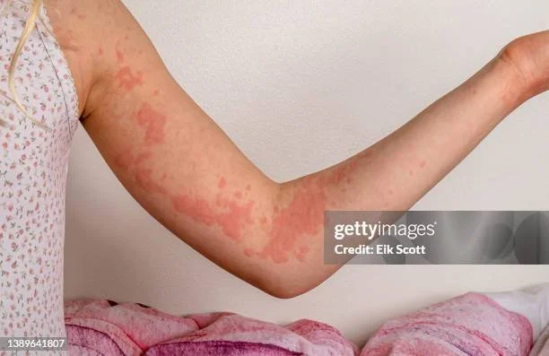 Spot the Difference: Eczema vs. 5 Common Skin Mimickers