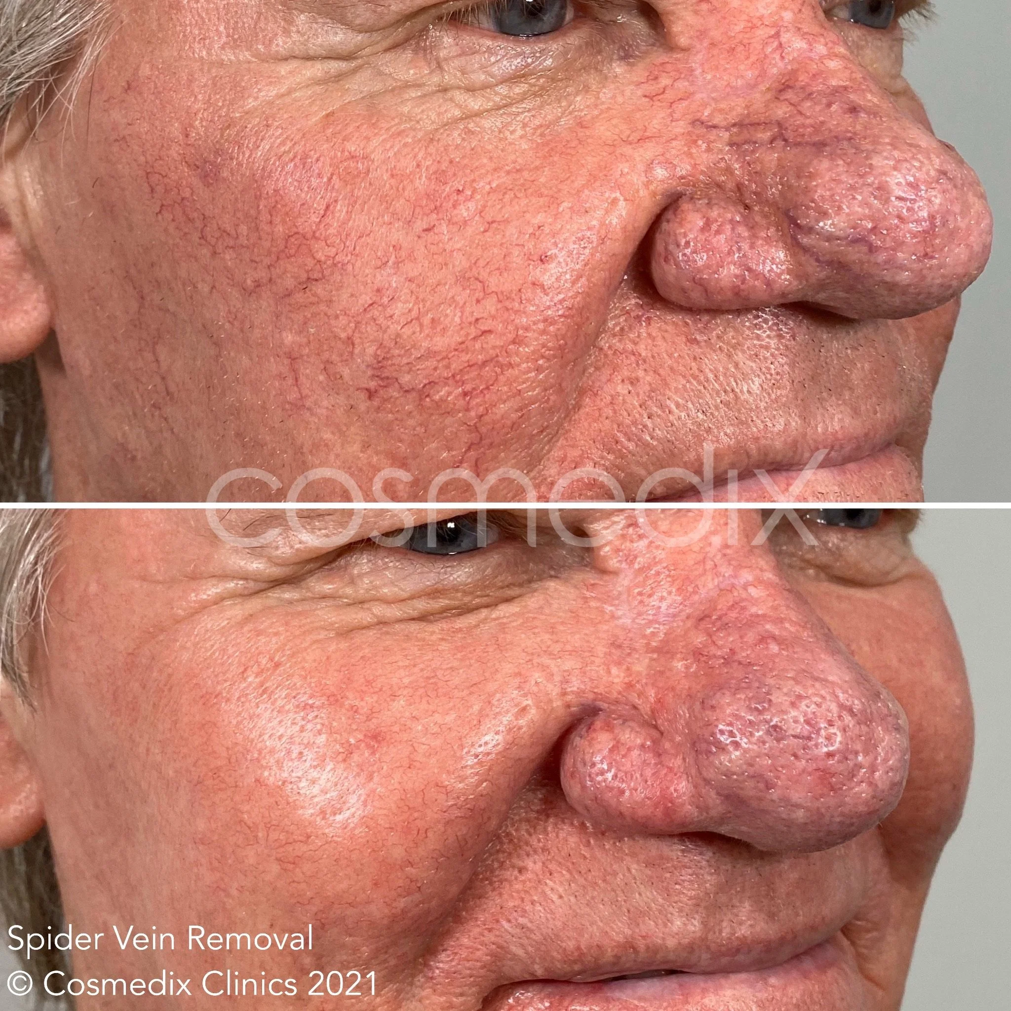 Man Face Spider Vein Removal & Rosacea Clearance - Cosmedix Clinics Sydney