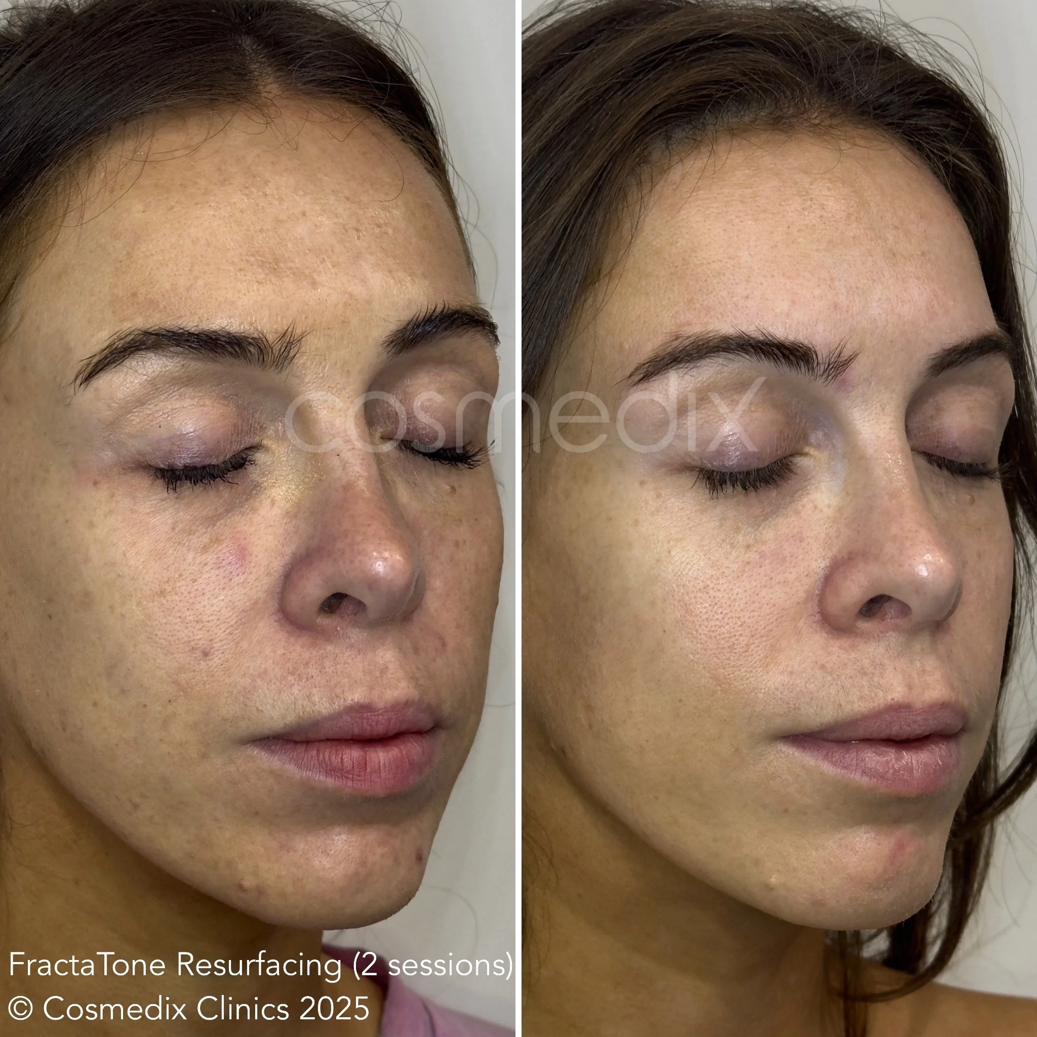 FractaTone Resurfacing - results after 2 sessions