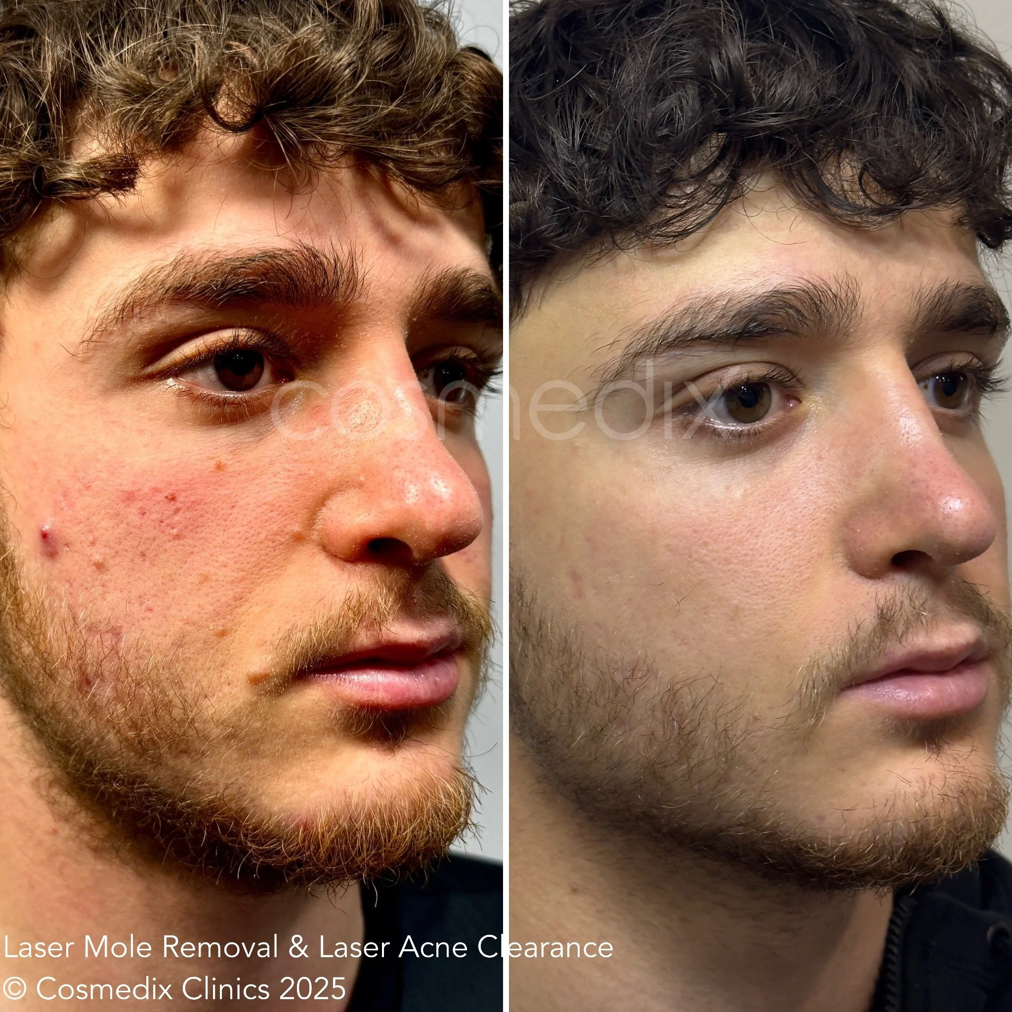 2025 Acne and Mole Removal - Raffi Behr.JPG
