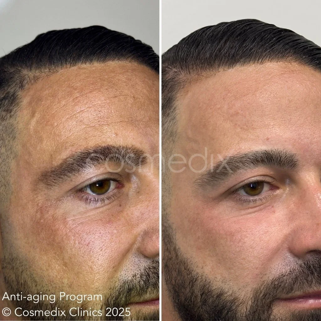 Fractiona Laser Resurfacing - Cosmedix Clinics, Sydney.JPG