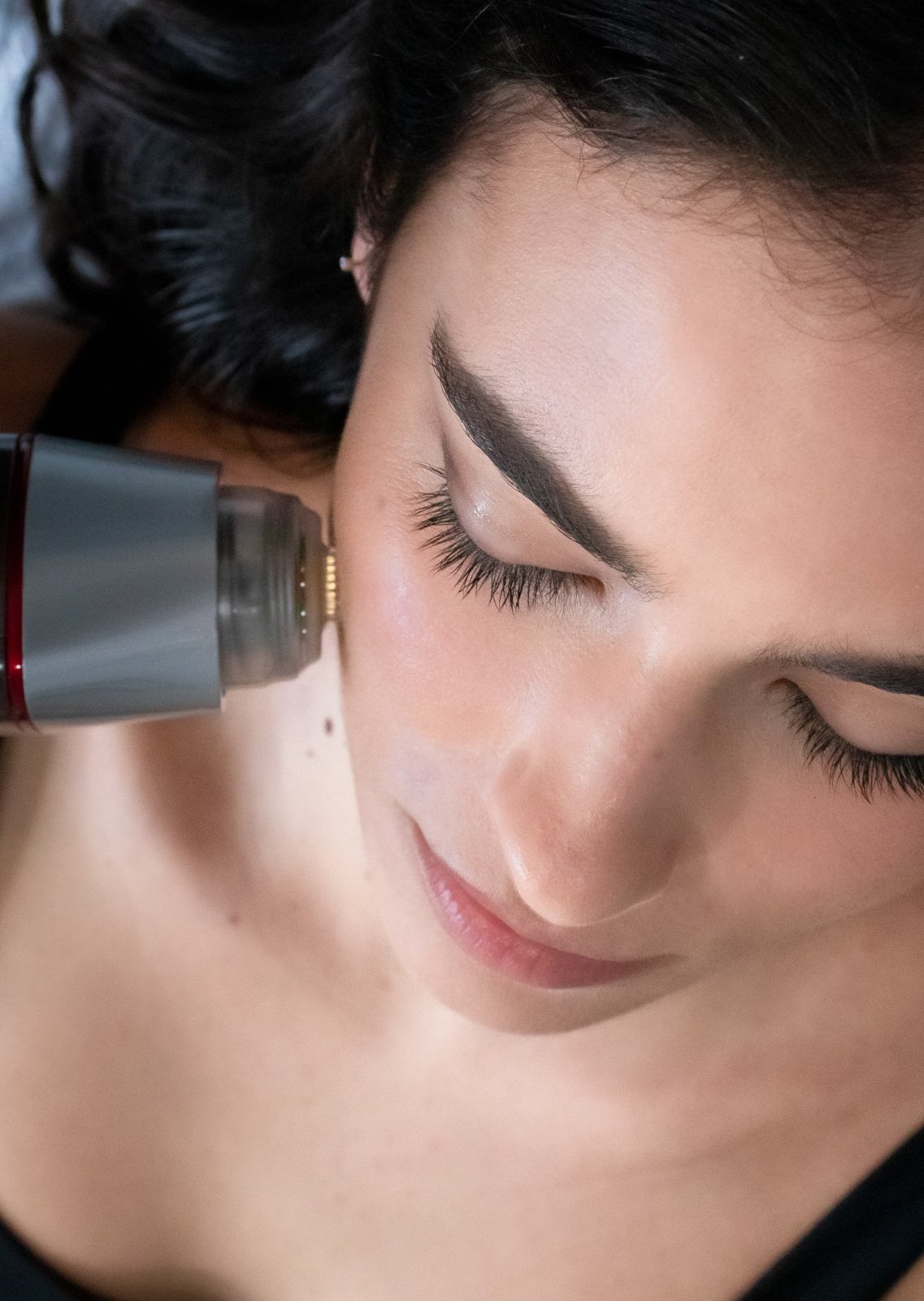 Cosmedix Clinics Sydney Skin Treatment Scar Acne Facial Face Beauty Microneedle Fractional RF
